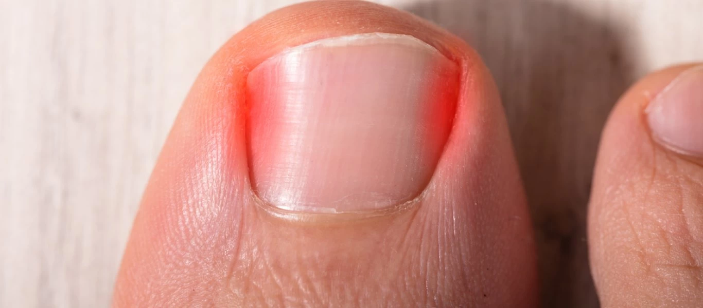 Νύχι που γυρίζει προς τα μέσα: Πως να το αντιμετωπίσετε